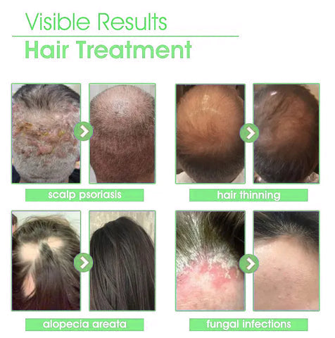 Piguiay® Hair Follicle Repair Hair Growth Solution - Latest microneedle system, rapid absorption,Achieve thicker hair quickly🌞